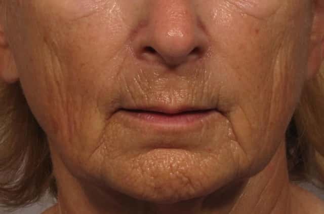 Before Frontal photo of facelift with upper lip lift and fat grafting