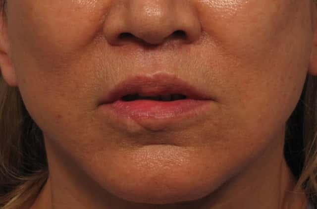 4 Month post-op frontal view photo of upper lip lift