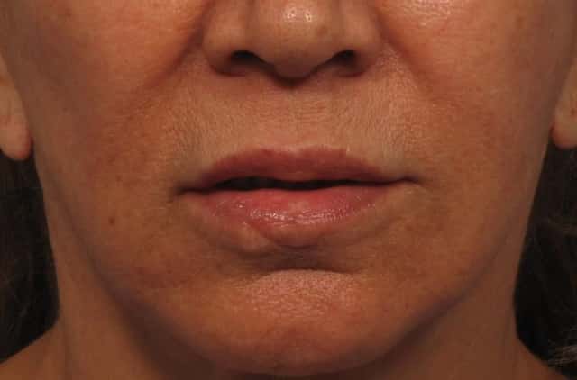Before photo frontal view of upper lip lift