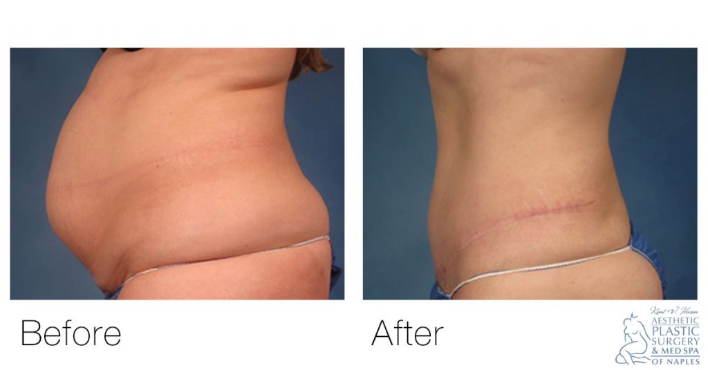CoolSculpting® vs. Liposuction vs. Tummy Tuck: Recovery Time & Results  (Pictures)