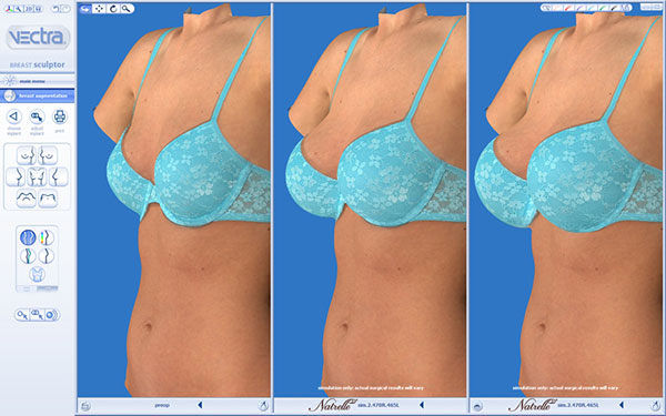 VECTRA® 3-D Plastic Surgery Imaging for Naples & Fort Myers, FL