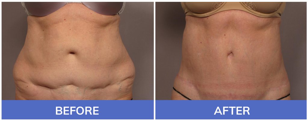 Best Tummy Tuck Before & After Pictures  Naples & Fort Myers – Kent V.  Hasen, MD